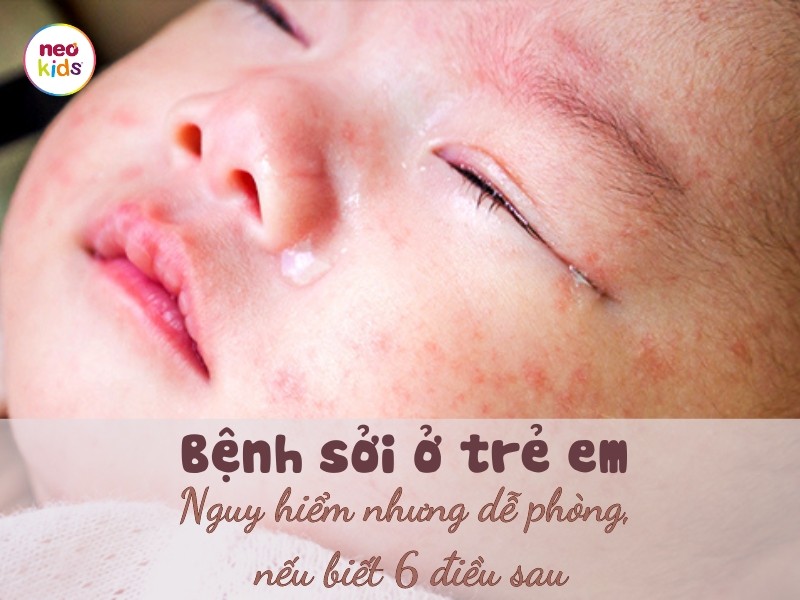 Bệnh sởi ở trẻ em: Nguy hiểm nhưng dễ phòng nếu biết 6 điều sau